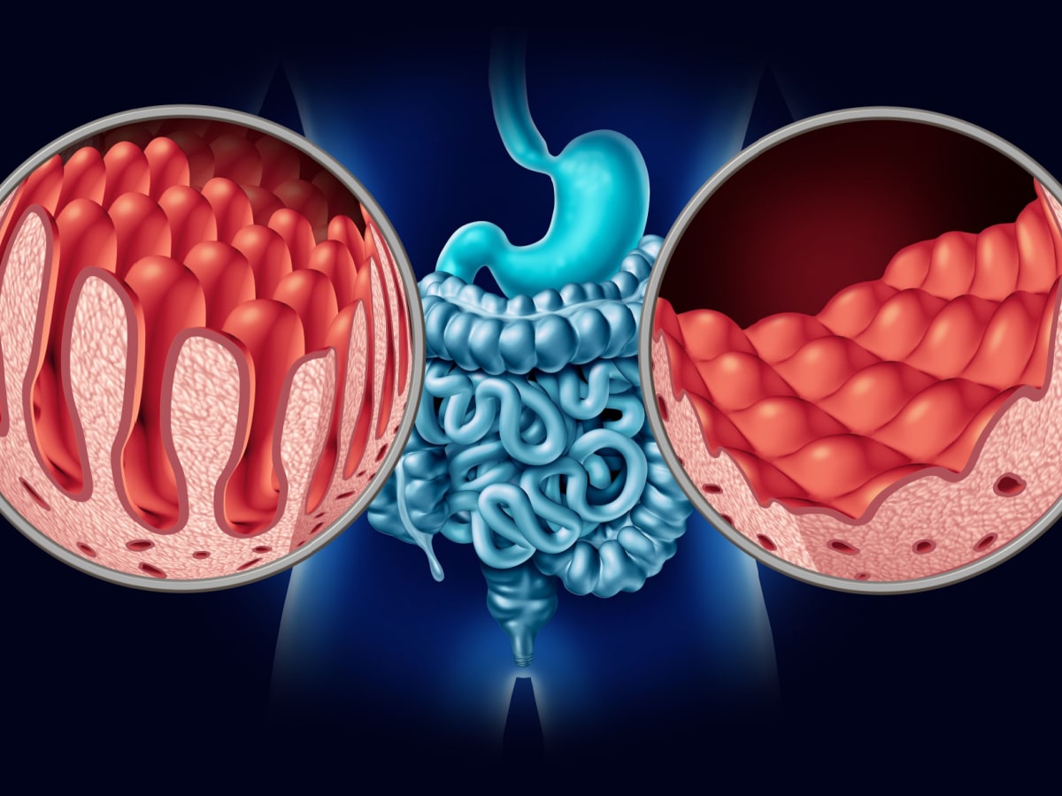 Coeliac Disease Vs Gluten Intolerance – The Difference - BK Nation